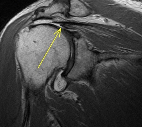 Figure 4 for case Supraspinatus and subscapularis tears involving the anterior rotator cable